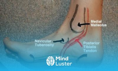 Posterior Tibial Tendinitis Evaluation with Paul Marquis PT
