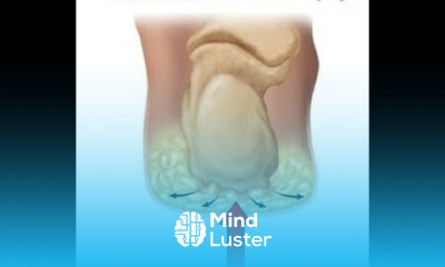 Calcaneal fat pad atrophy What is it and what does it look like