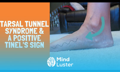 Tarsal Tunnel Syndrome with a Positive Tinel s Sign