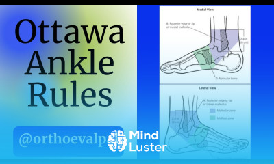 Ottawa Ankle Rules To x ray or not to x ray