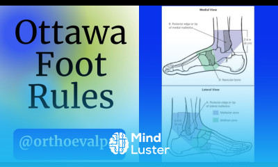 Ottawa Foot Rules To x ray or not to x ray