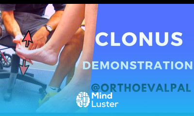 Clonus Demonstration with Ortho Eva Pal