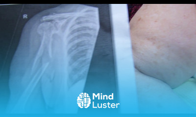 HUGE mid humeral fracture