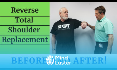 Learn Reverse Total Shoulder Replacement Before After - Mind Luster