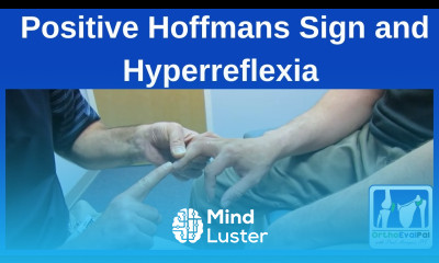 Positive Hoffmans Sign and Hyperreflexia