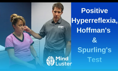 Positive Hoffman s Sign Hyperreflexia and Spurling s Test