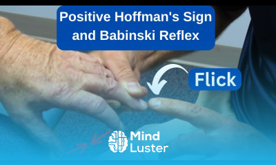 Positive Hoffman s Sign and Babinski Reflex in an MS Patient