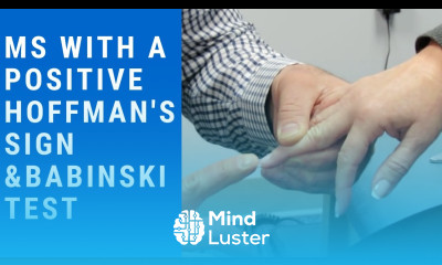 MS with positive Hoffman s sign and Babinski test