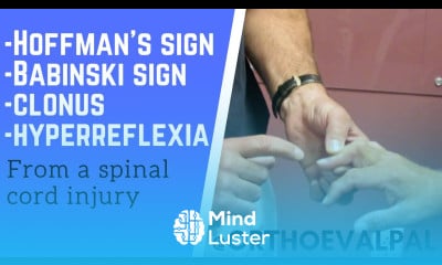 Positive Hoffman s sign and Babinski test clonus hyperreflexia in a C5 6 injury