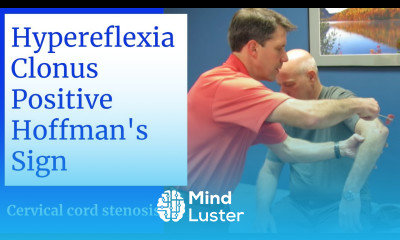 Hyperreflexia Clonus Positive Hoffman s Sign Central Cervical Spine Stenosis