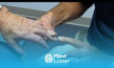 Positive Hoffman s sign and hyperreflexia with cervical spinal stenosis