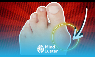 How To Fix Bunions Without Surgery