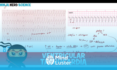 Rate and Rhythm Ventricular Tachycardia