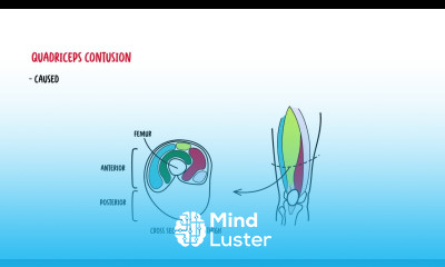 Quadriceps Muscle quadriceps mujscle injury strain quadriceps contusion