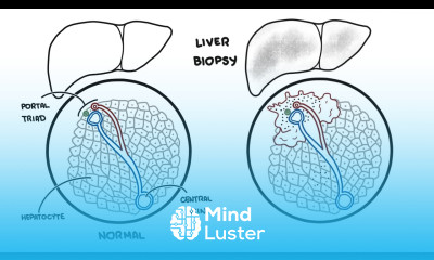 Autoimmune Hepatitis