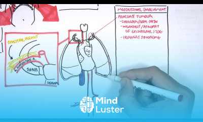 Lung Carcinoma Lung cancer