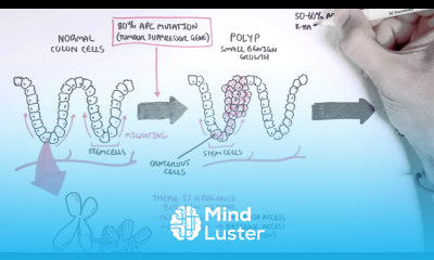 Colon Cancer Carcinogensis