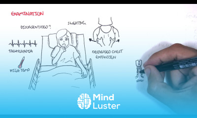 Community Acquired Pneumonia DETAILED Overview