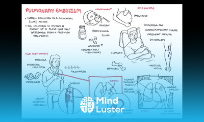 Pulmonary Embolism Overview