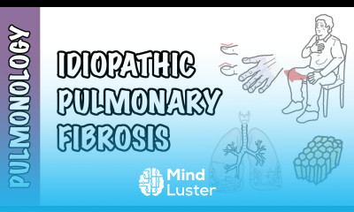 Idiopathic Pulmonary Fibrosis pathophysiology signs and symptoms investigation and treatment