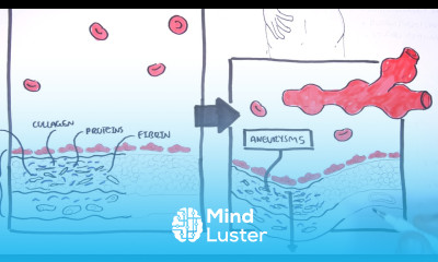 Polyarteritis Nodosa and Kawasaki Disease Medium Vessel Vasculitis Symptoms pathophysiology
