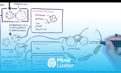 Systemic Lupus Erythematosus SLE signs and symptoms pathophysiology investigations treatment