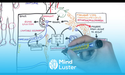 Rheumatoid Arthritis Pathophysiology signs and symptoms