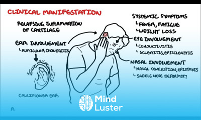 Relapsing Polychondritis