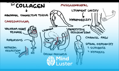 Ehlers Danlos Syndromes