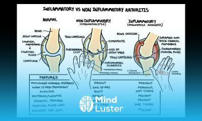 Inflammatory vs non inflammatory arthritis