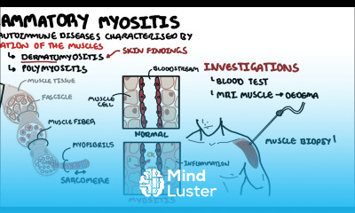 Idiopathic Inflammatory Myopathies Dermatomyositis Polymyositis Antisynthetase syndrome