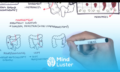 Colorectal Cancer Overview