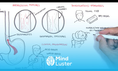 GORD GERD Gastro Oesophageal Reflux Disease Overview pathophysiology treatment