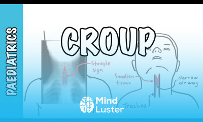 What is Croup larynotracheobronchitis symptoms pathophysiology investigations treatment