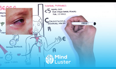 Kawasaki Disease vasculitis symptoms pathophysiology treatment