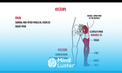 Piriformis Syndrome buttock pain siatica