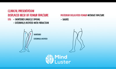 Understanding Neck of Femur Fractures