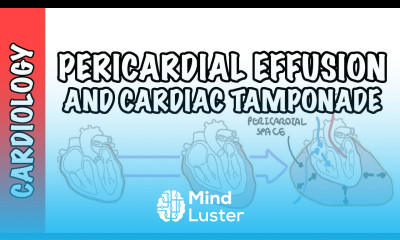 Cardiac Tamponade pericardial effusion causes pathophysiology investigations and treatment