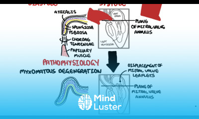 Mitral Valve Prolapse