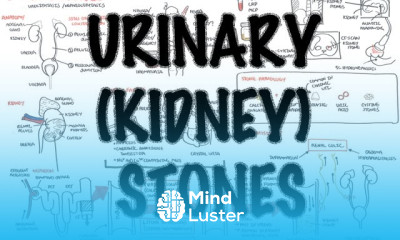 Urinary Kidney Stones Overview signs and symptoms risk factors pathophysiology treatment