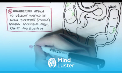 Giardiasis Giardia Lamblia