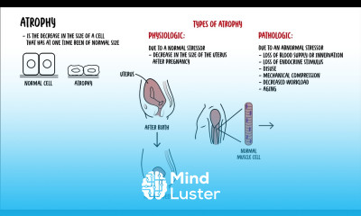 Cellular Adaptation hyperplasia hypertrophy atrophy and metaplasia cell injury