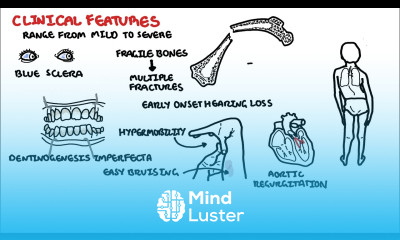 Osteogenesis Imperfecta