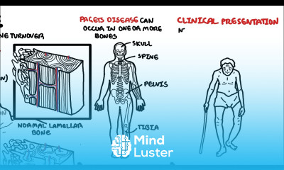 Paget s Disease of the bone