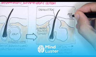 Acne Pathophsyiology