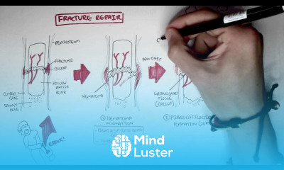 Bone Fracture Types Fracture Repair and Osteomyelitis