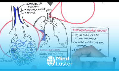 PART I Pneumonia Overview Lobar and Bronchopneumonia