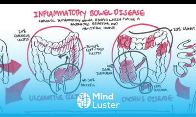 Inflammatory Bowel Disease Crohns and Ulcerative Colitits
