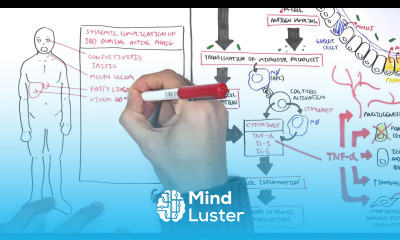 Inflammatory Bowel Disease Pathophysiology and Complications