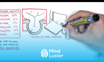 Introduction to Direct and Indirect Inguinal Hernia